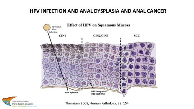 anal cell carcinoma What causes anal